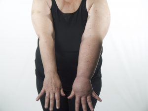 woman with arm lymphedema in one arm