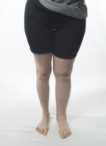 woman with leg lymphedema
