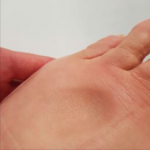 foot with pitting edema