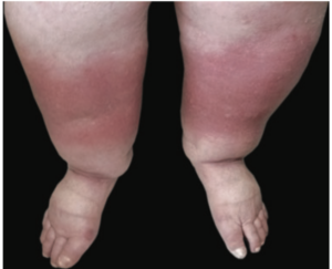 Lipedema legs that show ankle cuff and redness on the skin indicating infection