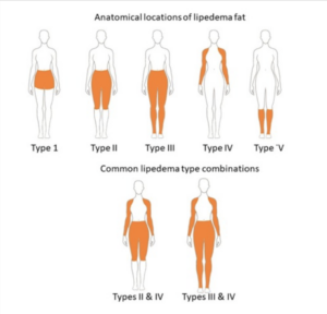 Image of figures of the human form with orange shading indicating the area of lipedema by type. 