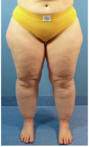 Woman with yellow short with lipedema in her legs