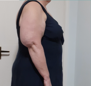 Woman in profile showing arm with lipedema
