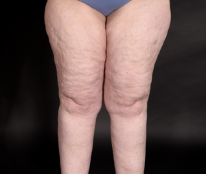 image of women's legs with lipedema