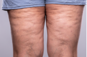legs with cellulite