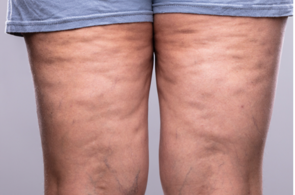 Lipedema Vs Cellulite Lipedema Stages And More