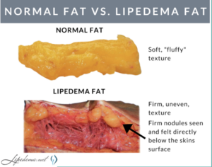 normal fat and lipedema fat