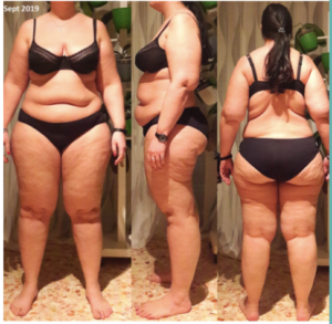Front, side and back view of woman with lipedema wearing black bra and underwear