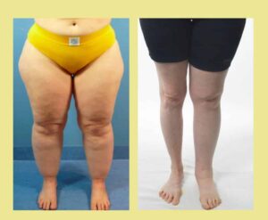 two sets of legs, one with lipedema and one with lymphedema with the words lipedema vs lymphedema above the images
