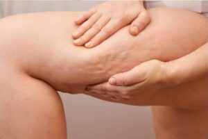 A person with their hands on their thighs showing cellulite in the skin