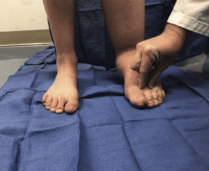 Feet on a blue cloth with hand pinching the skin at the base of the second toe.