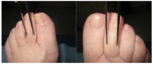 Two feet with forceps being used to pinch the second toe.