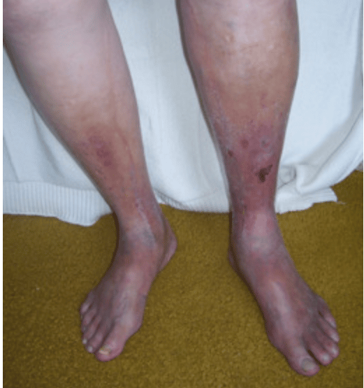 Edema vs Lymphedema