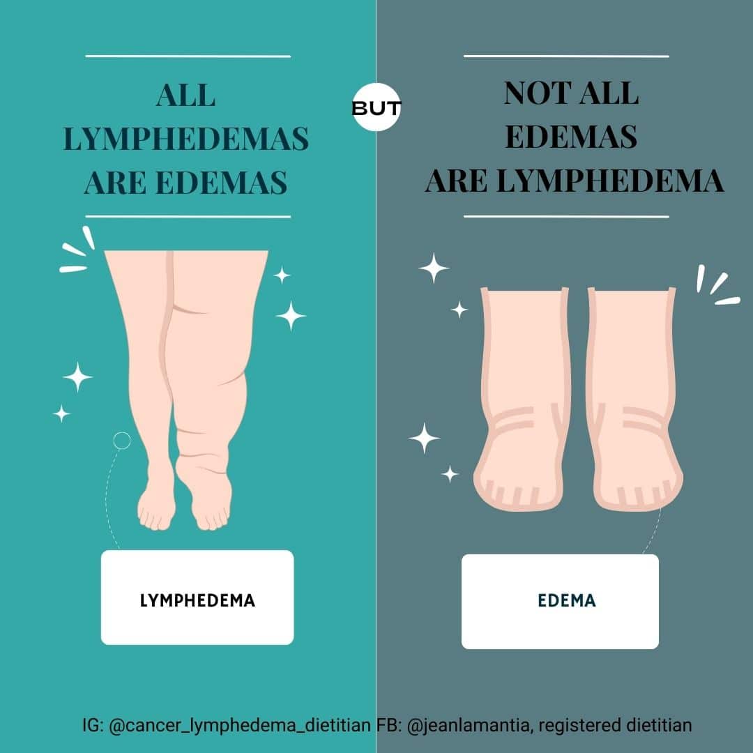 Edema Vs Lymphedema – Anticancerhealth.com